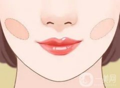 双下巴吸脂的果可以维持多久?