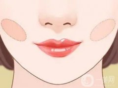 什么是颊脂垫？为什么要做颊脂垫？