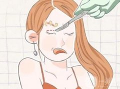 双眼皮是如何形成的?