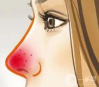 哪些因素影响酒渣鼻整形的价格?