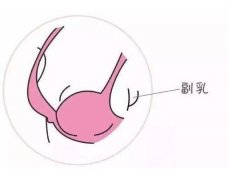 副乳吸脂好还是手术果好