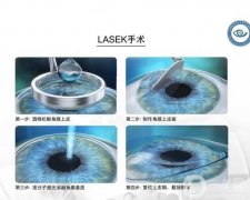 准分子激光手术价格多少钱？