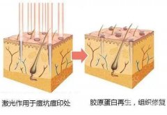 做激光点阵疼吗，可以用麻药吗？