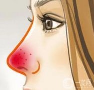 酒渣鼻怎么调节？病因是什么？