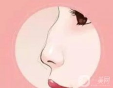 驼峰鼻的分类及矫正方法?