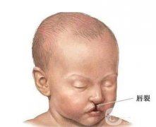 唇裂形成的因素？术后怎么护理？