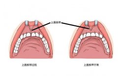 唇系带整形手术的方法和步骤？