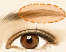 有哪些常见的眉弓整形方法？