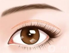 什么叫生物焊接双眼皮?讲解生物焊接双眼皮的手术特点和好处是什么?
