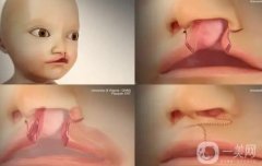 唇腭裂修复术后的护理