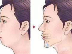 垫下巴多长时间可以消肿？吃什么比较好？