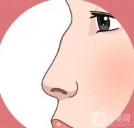 驼峰鼻矫正有哪些后遗症？如何降低驼峰鼻矫正的风险？