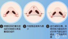 如果鼻翼缩小手术失败了怎么办？鼻翼缩小手术是如何进行的？