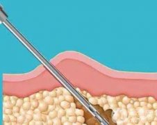 与传统抽脂及冷冻脂肪溶解仪的区别？