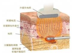射频紧肤适合哪些人群？果怎么样？