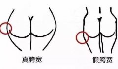 假胯宽能不能抽脂？如何判断自己是不是假胯宽？
