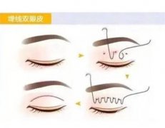 【解答帖】埋线双眼皮的价格和手术流程？