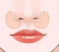 决定垫鼻基底价格的因素？价格大概是多少？