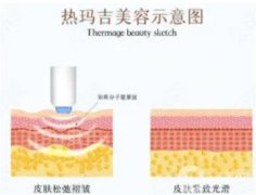 热玛吉和其他双极或多极射频之间有什么区别？