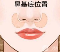 如何填充鼻基底凹陷才不会老？