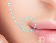 嘴角上扬手术适合谁？有什么危害