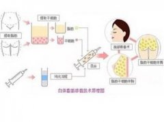 自体脂肪填充有哪些问题？