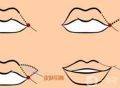 嘴角上扬手术会不会留疤？恢复期是多久？