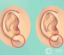 玻尿酸丰耳垂的副作用和危害？