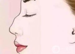 矫正驼峰鼻能维持多久？是*的吗？