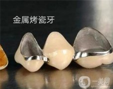 烤瓷牙有哪些种类？