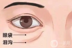 泪沟填充失败了应该怎么办？玻尿酸填充泪沟术的优点有哪些？