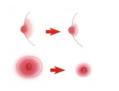 男性可以做乳晕缩小手术吗？