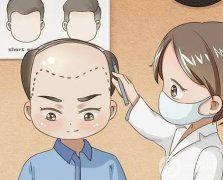 种植发际线的价格是多少?