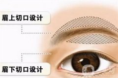 假体垫眉弓有哪些优势？适合假体垫眉弓的人群有哪些?