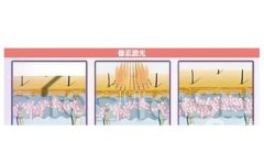 像素激光和点阵激光有哪些区别？