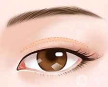 提上睑肌缩短会导致哪些后遗症？