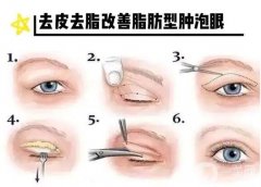 眼皮抽脂有需要忌口的吗？