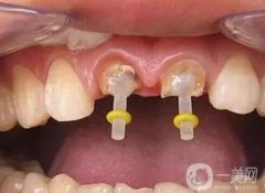 什么是桩核冠修复？有什么优势