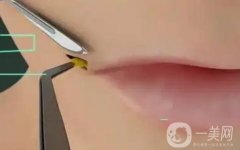 什么是嘴角上扬手术？不适合哪些人