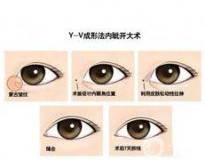 手术设计与开内眼角的果有关系吗？