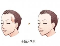 太阳穴凹陷应该怎么办？太阳穴凹陷有什么特点？