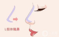 隆鼻假体取出的必要条件是什么？需要注意什么？