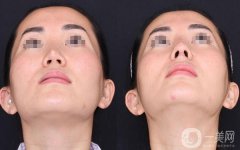 做硅胶隆鼻调节果怎么样?果保持时间多久?