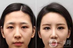 做自体脂肪去眉间纹调节果怎么样?果保持时间多久?