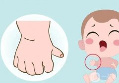 手指畸形有哪些类型？