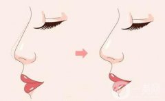自体脂肪可以隆鼻吗？有什么优缺点？
