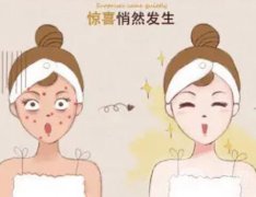 做激光后的注意事项有哪些呢？