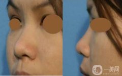 做肋软骨垫鼻尖调节果怎么样?果保持时间多久?