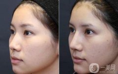 做隆鼻改良短鼻调节果怎么样?果保持时间多久?