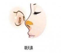 矫正朝天鼻的果怎么样？注意事项有哪些？